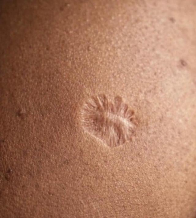 the-smallpox-vaccine-leaves-a-scar-because-it-was-given-v0-82zdu0sv7c3h1
