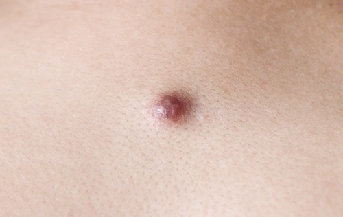 66ad07573be7bb15edda67e6_66ad06d0c4765d7545147a45_picture_2520of_2520Sebaceous_2520Cyst